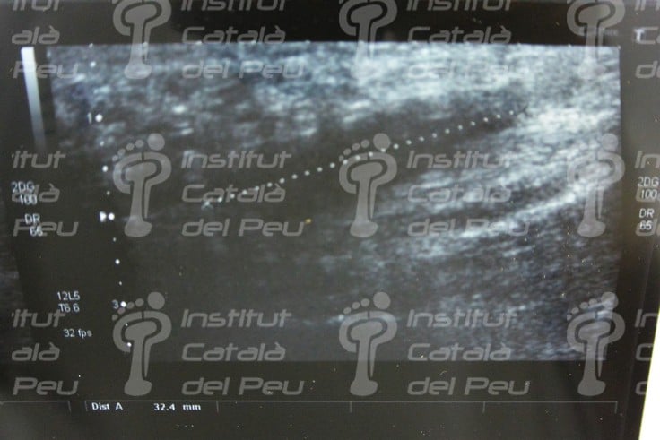 PLANTAR FASCITIS: SYMPTOMS AND TREATMENT.