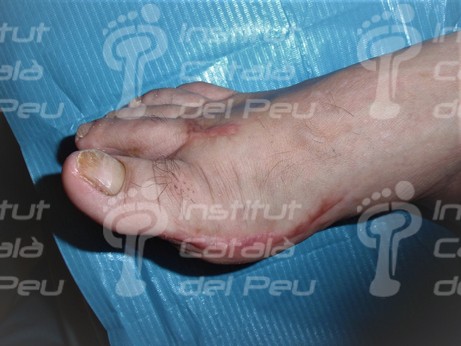 El tejido cicatricial: características.