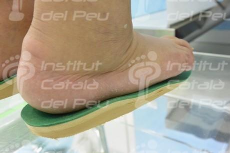 La artropatía neuropática o pie de Charcot.