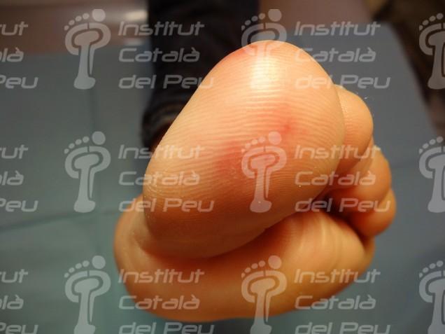 Els penellons o l’eritema perni.