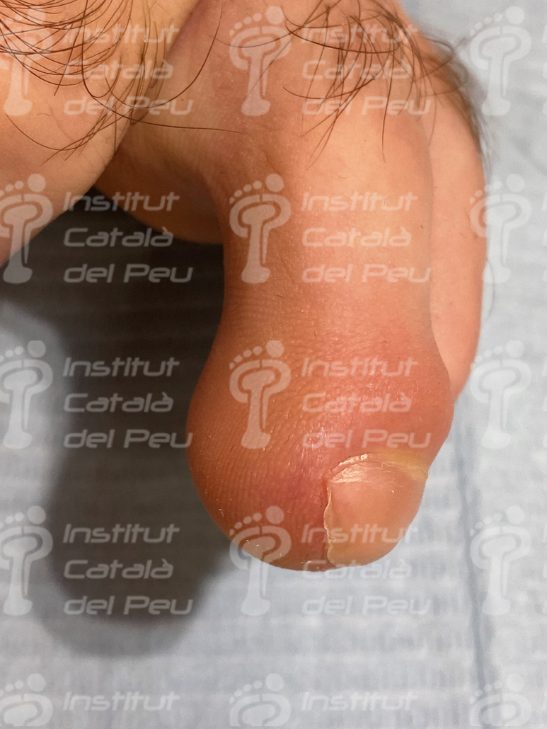 La macroniquia. Definición y causas