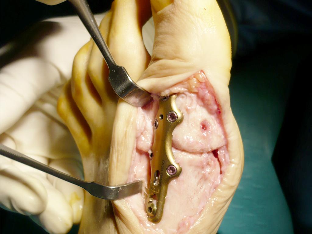 Cirugía Podológica