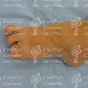 The agenesis in the lower extremity