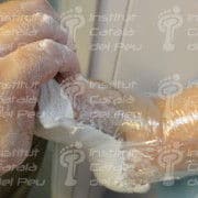 The agenesis in the lower extremity