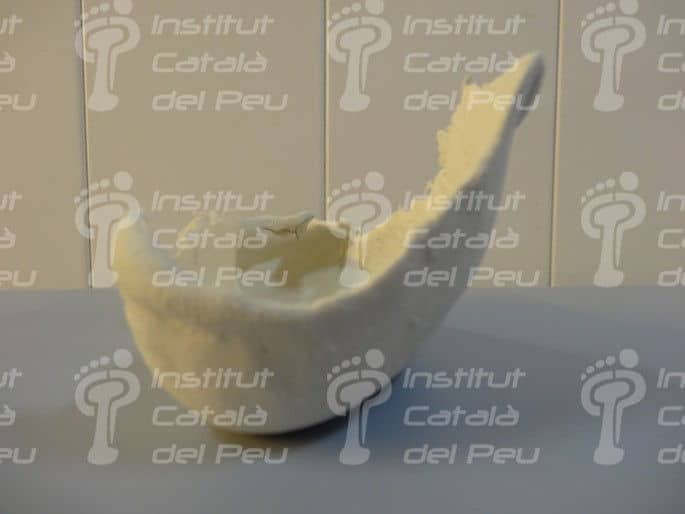 La agenesia en la extremidad inferior