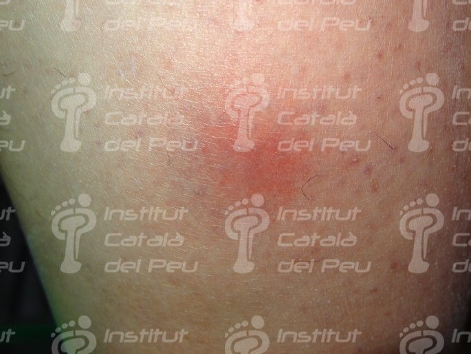 Alteraciones Dermatológicas